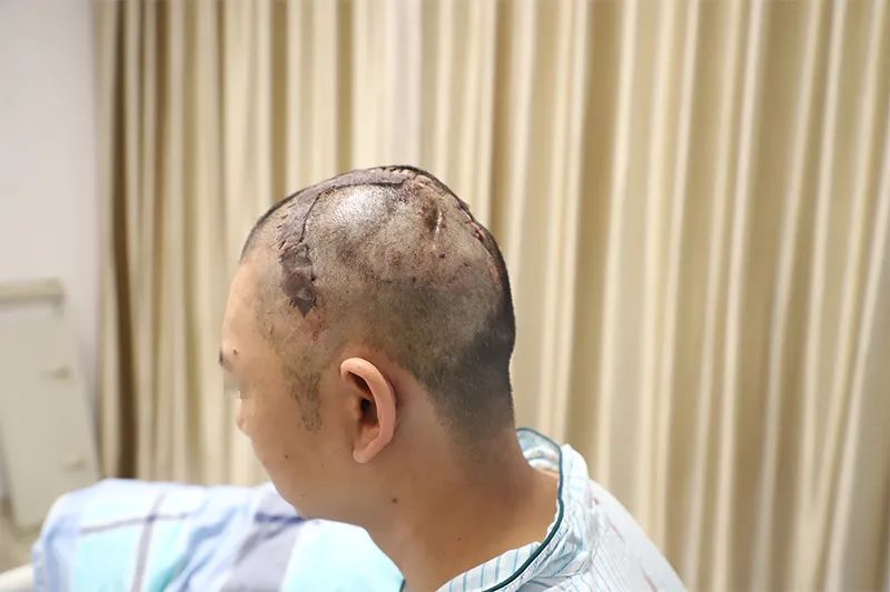 【医技动态】南方医院泰成逸园分院外科成功开展颅骨缺损修补术