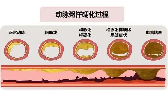 【设备介绍】动脉硬化检测仪——早期发现心脑血管病的利器