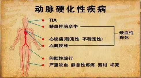 【设备介绍】动脉硬化检测仪——早期发现心脑血管病的利器